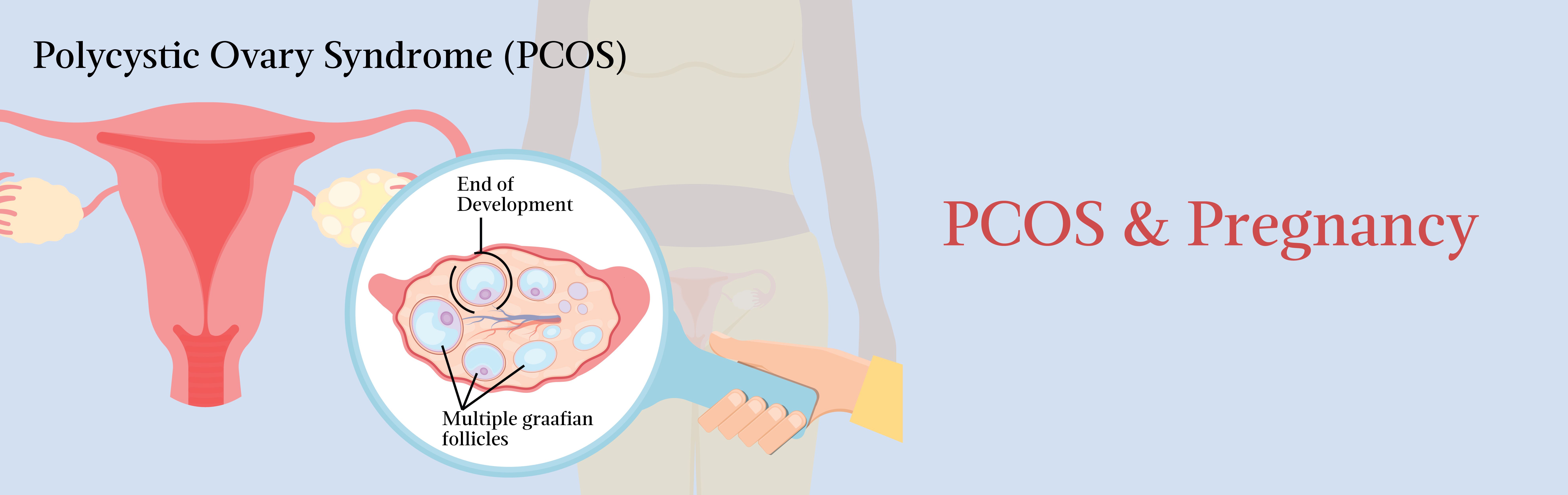 Polycystic ovarian syndrome (PCOS) and pregnancy Complications